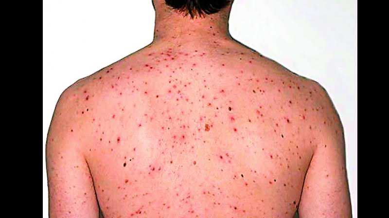 Monkeypox Virus Infection, Symptoms, Precautions, Cause, Treatment