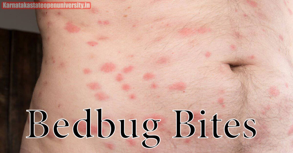 Bedbug Bites