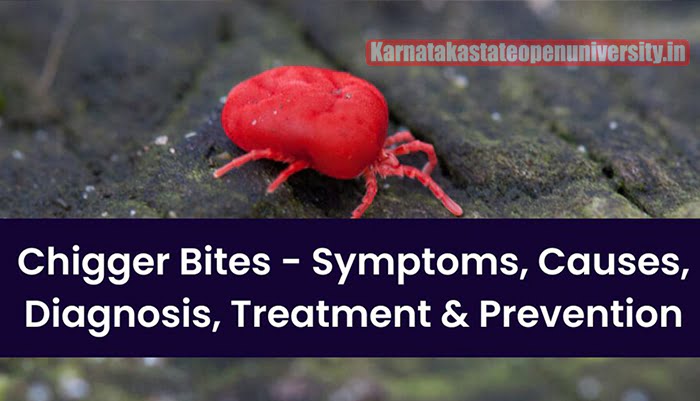 Chigger Bites Symptoms, Causes, Diagnosis, Treatment & Prevention